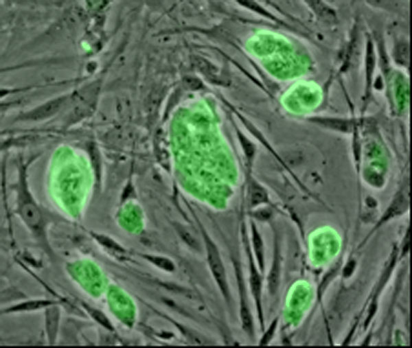 Stem cell therapy for knee cartilage regeneration in India Upsc